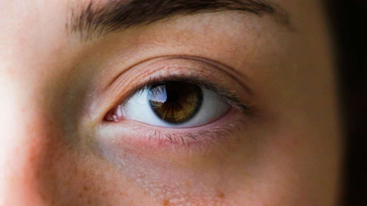 some useful facts about brown eyes with brown eyes symptoms